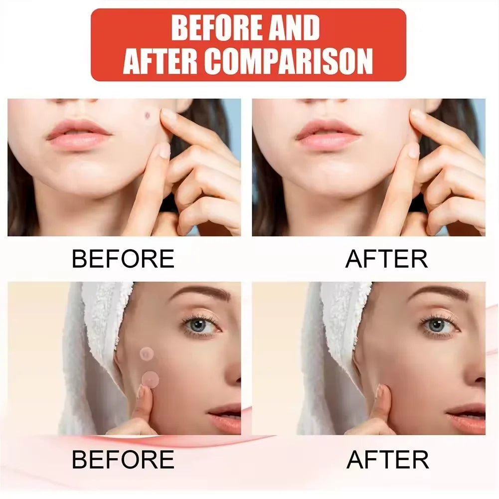 240pcs New Pimple Patch Acne Patches
